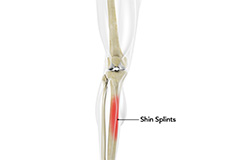 Picture of Shin Splints