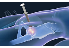 Picture of Stem Cell Therapy for the Knee