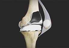 Picture of Tricompartmental Knee Replacement