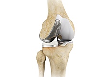 Picture of Unicompartmental/Partial Knee Replacement