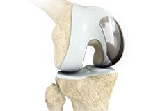 Picture of Unicondylar knee Replacement