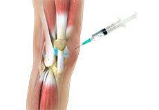 Picture of Viscosupplementation