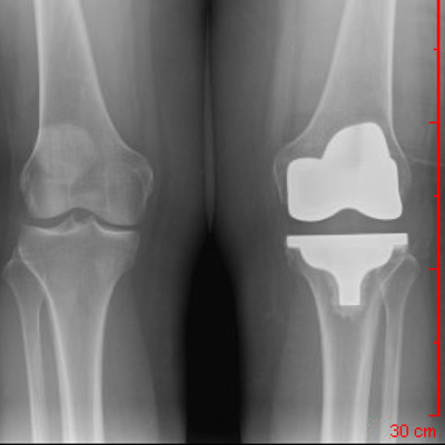 Anterior-Posterior View Total Knee Replacement  
