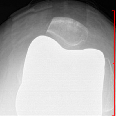 Axial View Total Knee Replacement
