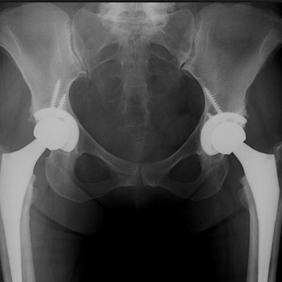 Bilateral Total Hip Replacement 