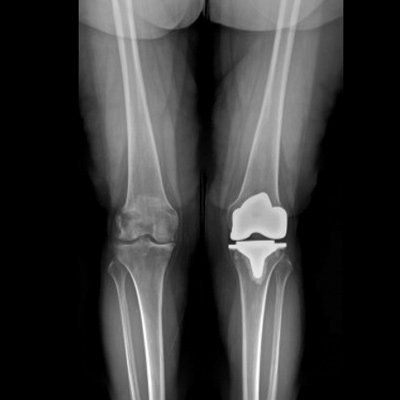 Kinematic Alignment Total Knee Replacement