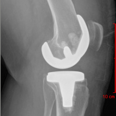 Lateral View Total Knee Replacement