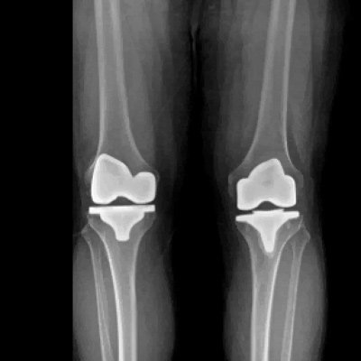 R knee: Mechanical Alignment - L knee: Kinematic Alignment