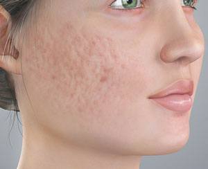 Acne Scarring pic