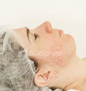 Acne pic