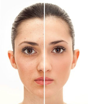 CO2 Laser Treatments pic