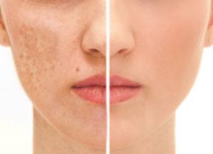Dermamelan Depigmentation Treatment pic