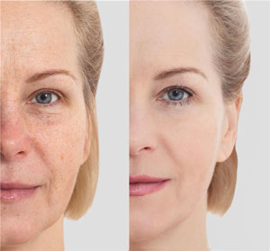 Fraxel Skin Resurfacing pic