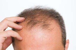 Hair Loss in Men pic