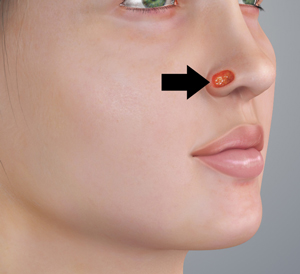 In Office Skin Cancer Excisions pic