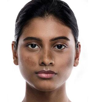 Melasma pic
