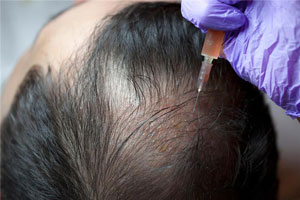 Platelet-rich Plasma (PRP) Therapy for Hair Loss pic