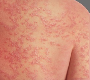 Psoriasis pic