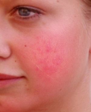 Rosacea pic