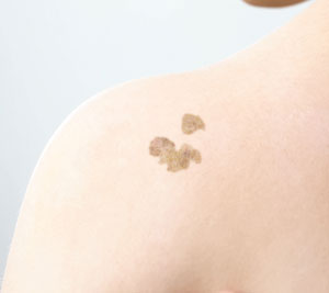 Seborrheic Keratosis pic