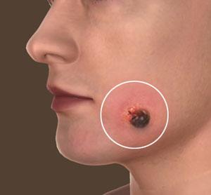 Skin Cancer/Mole Checks pic