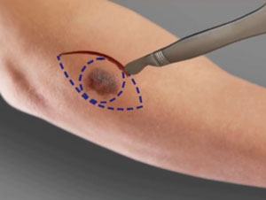 Skin Cancer Surgery pic