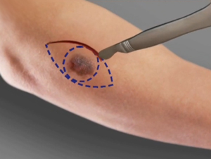 Skin Cancer Treatment and Reconstruction pic