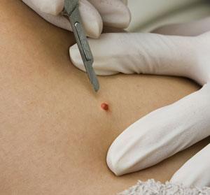 Skin Tag Removal pic