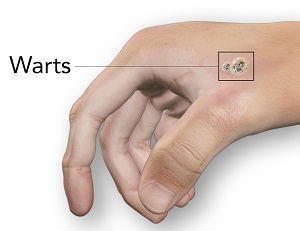 Warts pic