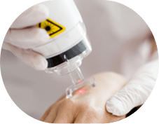 Laser <br>Treatments