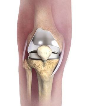 Complex Primary Knee Replacement pic