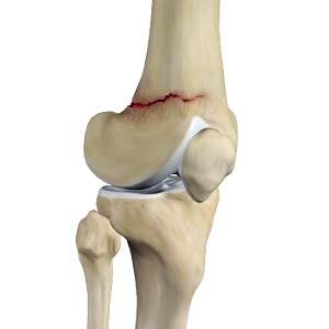 Distal Femur Fracture pic