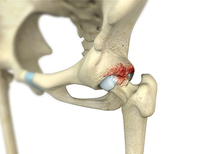 Femoroacetabular Impingement pic