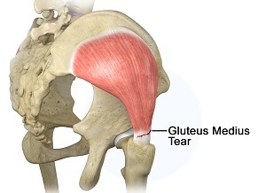 Gluteus Medius Tear pic