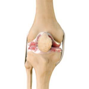 Knee Arthritis pic