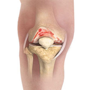 Knee Osteoarthritis pic