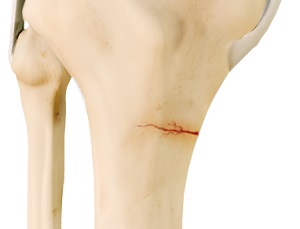 Knee Stress Fractures pic