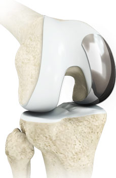 Minimally Invasive Partial Knee Replacements pic