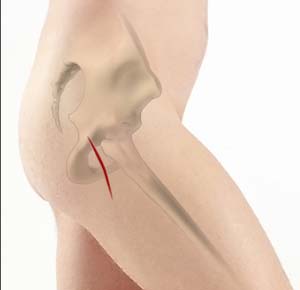 Posterior Hip Replacement pic