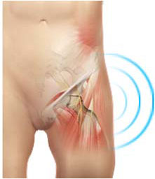 Snapping Hip Syndrome pic