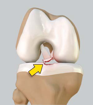 Tibial Eminence Fractures pic