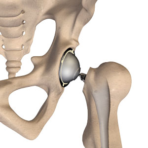 Total Hip Replacement pic