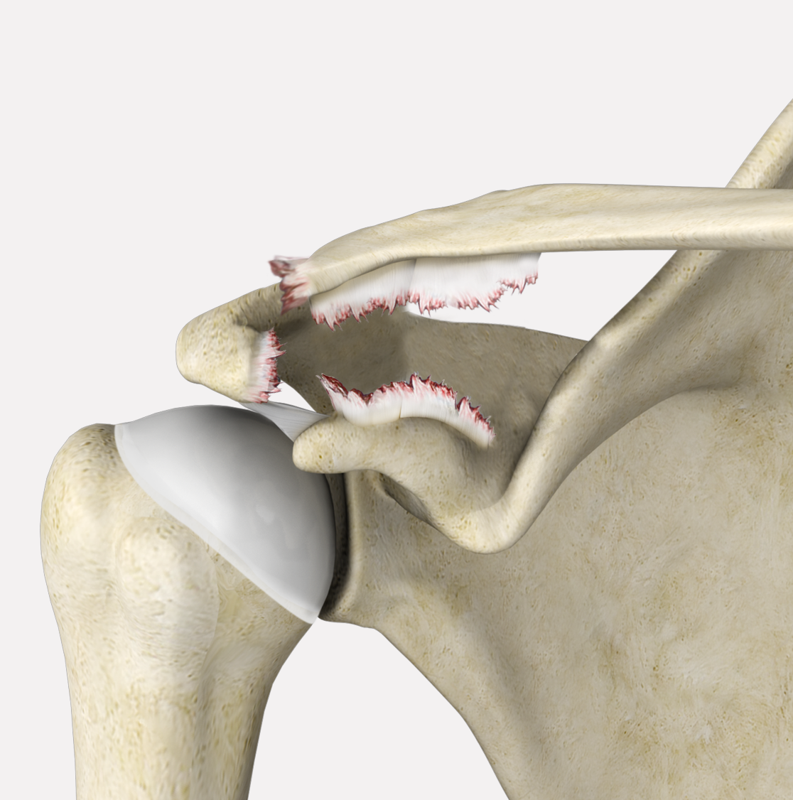 AC Joint Separation Images