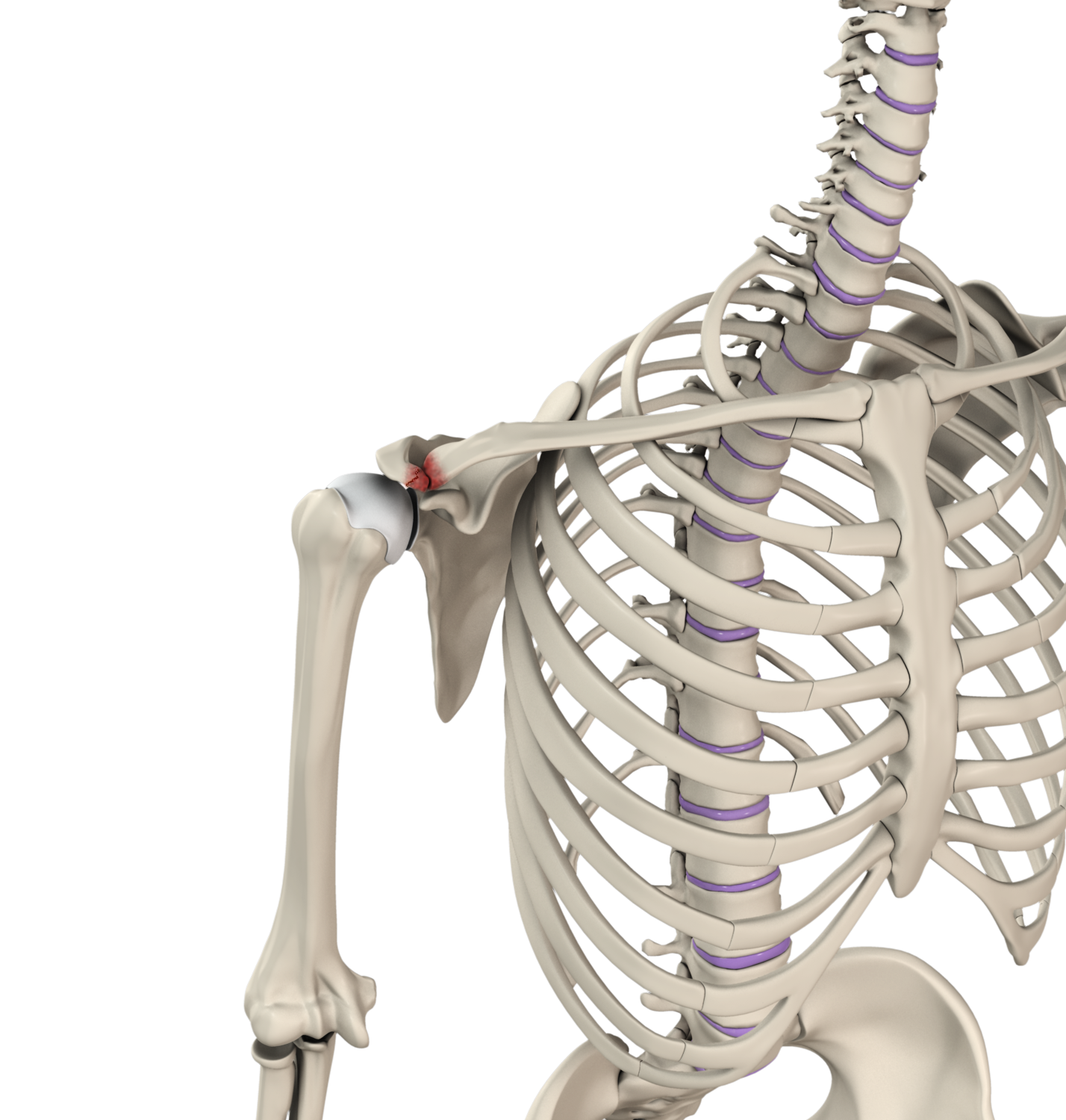 Acromioclavicular (AC) Joint Injuries Images