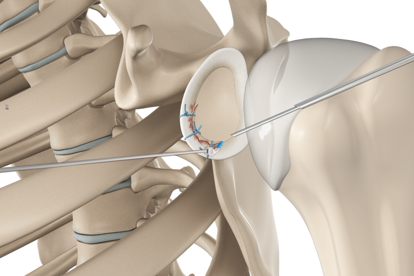 Arthroscopic Bankart Repair Images
