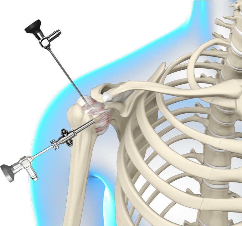 Arthroscopic Frozen Shoulder Release Images