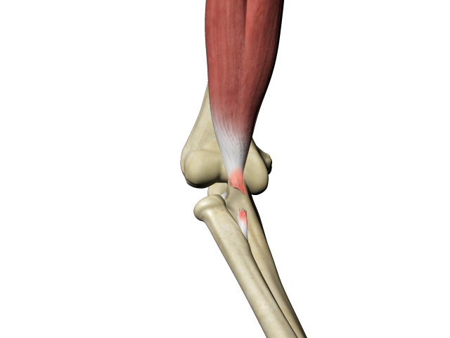 Distal Biceps Avulsion Images