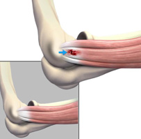 Epicondylitis Images