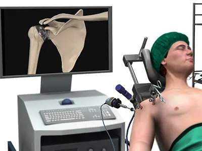 Minimally Invasive Shoulder Joint Replacement Images