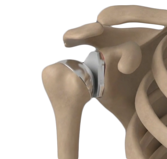 Outpatient Shoulder Replacement Images